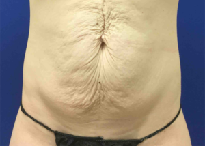 Tummy Tuck Before and After Pictures Bucks County, PA and Hunterdon County, NJ