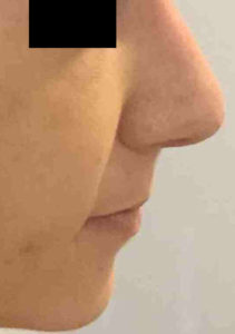 Rhinoplasty Before and After Pictures Bucks County, PA and Hunterdon County, NJ