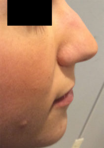 Rhinoplasty Before and After Pictures Bucks County, PA, and Hunterdon County, NJ