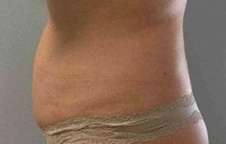 Before and after: CoolSculpting