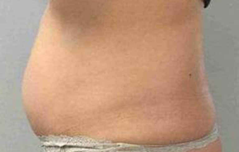 Before and after: CoolSculpting
