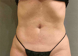 EMSCULPT Before and After Pictures Bucks County, PA and Hunterdon County, NJ