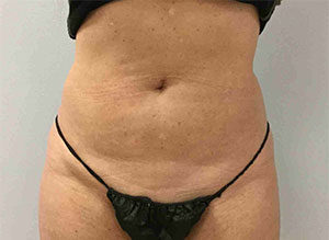 EMSCULPT Before and After Pictures in Bucks County, PA, and Hunterdon County, NJ