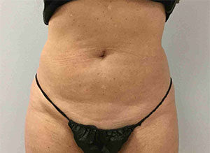 EMSCULPT Before and After Pictures Bucks County, PA and Hunterdon County, NJ