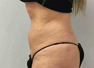 EMSCULPT Before and After Pictures Bucks County, PA and Hunterdon County, NJ