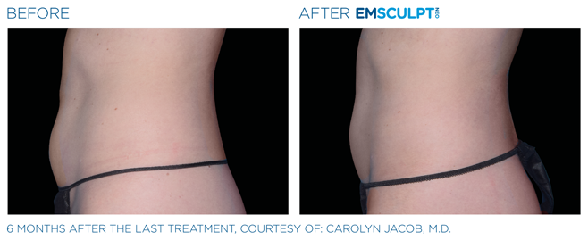 EMSCULPT NEO IN BUCKS COUNTY, PA, AND HUNTERDON COUNTY, NJ