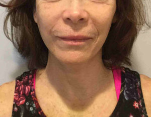 Facelift Before and After Pictures Bucks County, PA and Hunterdon County, NJ