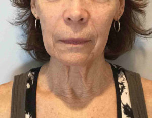 Facelift Before and After Pictures Bucks County, PA and Hunterdon County, NJ