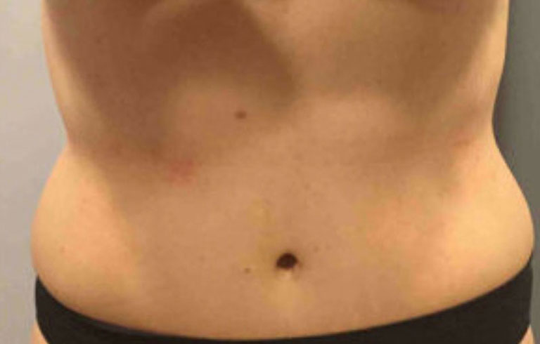 Before and after: body contouring