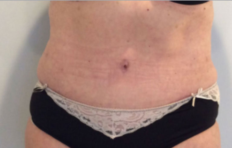 Before and after: body contouring
