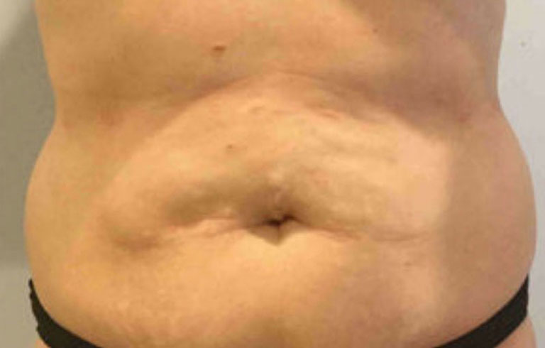 Before and after: body contouring