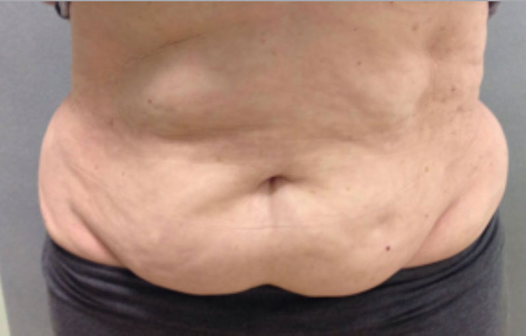 Before and after: body contouring